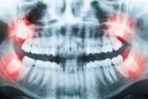 wisdom-tooth-extraction