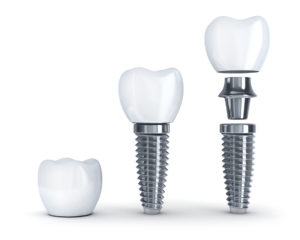 dental-implants-in-hutchinson/