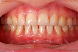 observes-gum-disease-awareness