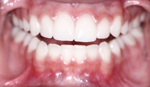 causes-of-tooth-discoloration