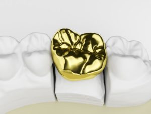 dental-crowns-in-hutchinson