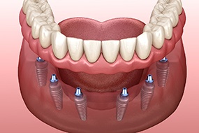 dentures-cost-3