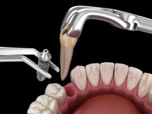 tooth-extratcion-after-dental-implants