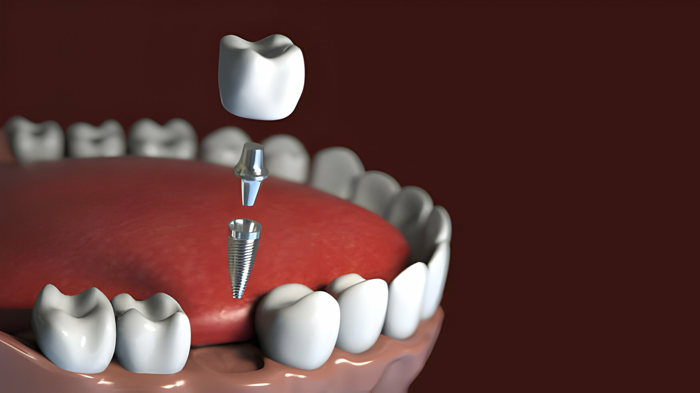 Living With Dental Implants: What To Expect After Surgery_FI