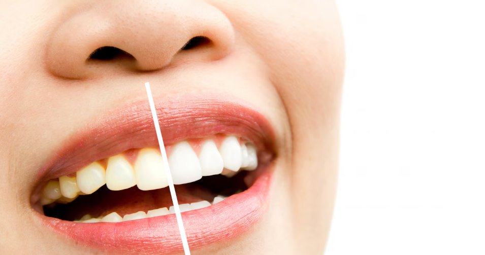 In-Office vs. At-Home Teeth Whitening in Hutchinson, KS