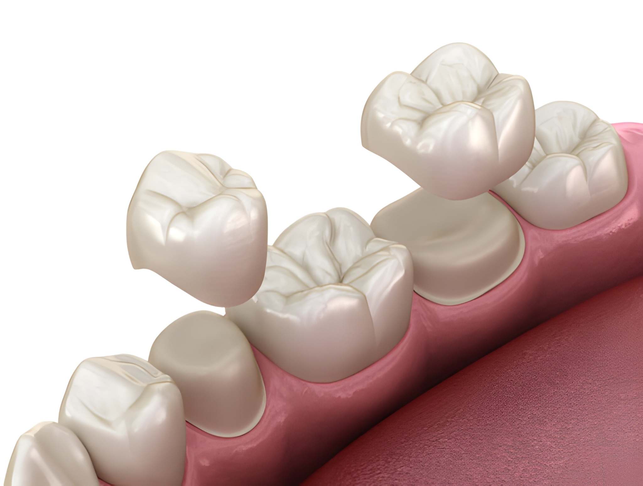 A Complete Guide to Dental Crowns at Grant D. Ringler, DDS in Hutchinson, KS_FI