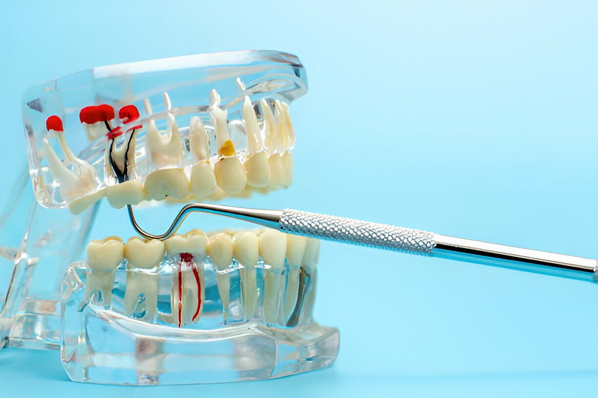 Root Canal Alternatives in Hutchinson, KS: Exploring Your Treatment Options_FI